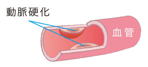動脈硬化の図
