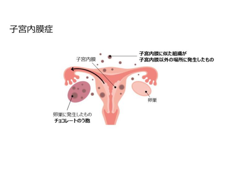 子宮内膜症の図
